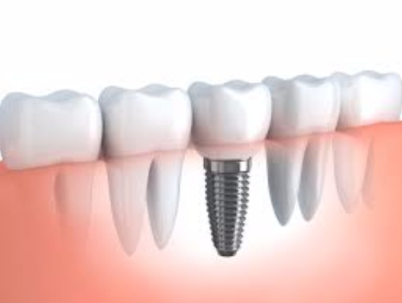 implante dental fuengirola